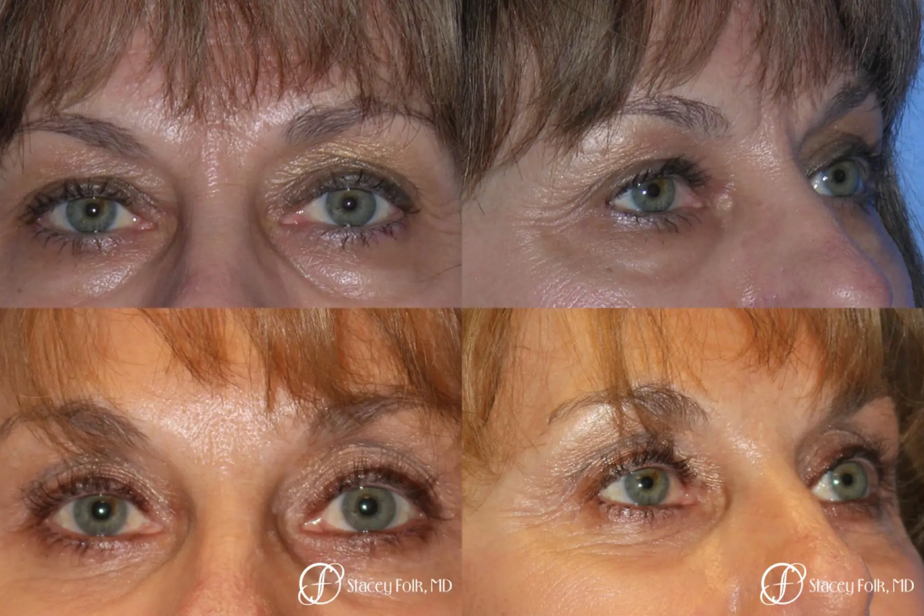 Denver Brow lift, Upper and Lower Lid Blepharoplasty 7162 - Before and After