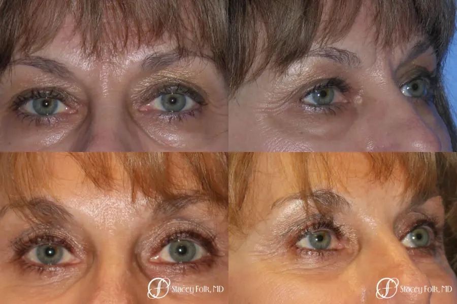 Denver Brow lift, Upper and Lower Lid Blepharoplasty 7162 - Before and After 1