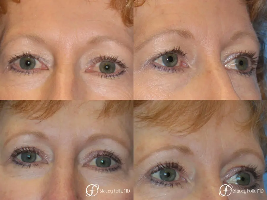Denver Blepharoplasty 10316 - Before and After 1