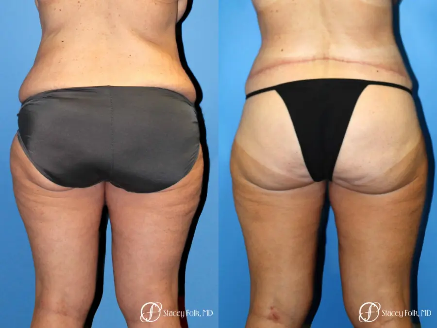 Denver Body Lift belt lipectomy, liposuction, mastopexy 5935 - Before and After 2
