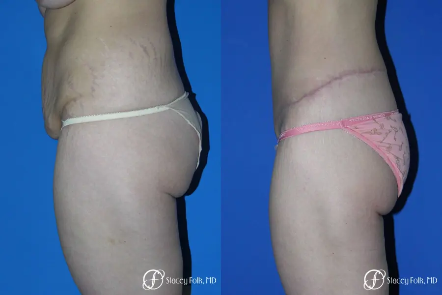 Denver Body Lift Belt lipectomy 5262 - Before and After 3