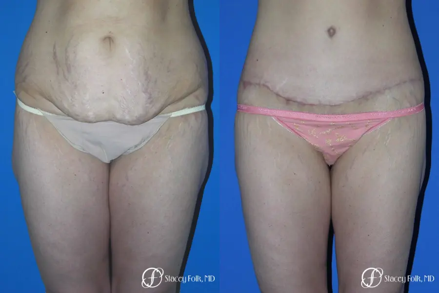 Denver Body Lift Belt lipectomy 5262 - Before and After 1