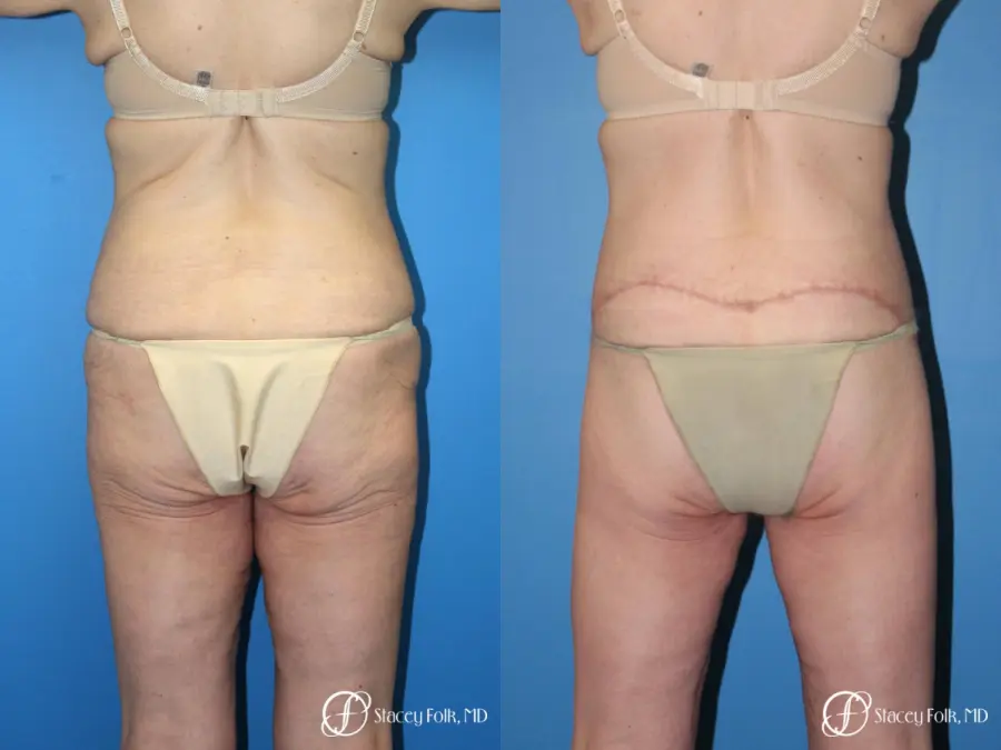 Denver Body Lift Belt lipectomy 5268 - Before and After 2