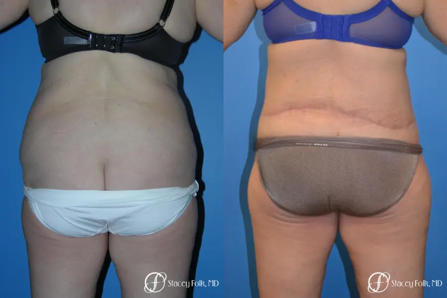 Denver Body Lift 4796 - Before and After 2