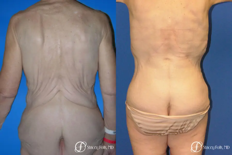Denver Body Lift 5299 - Before and After 2