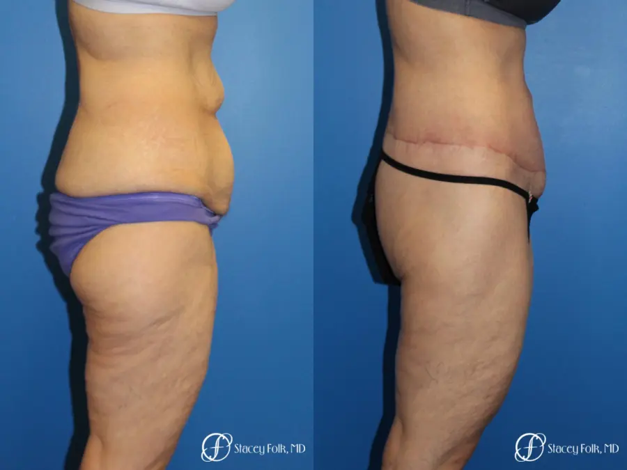 Denver Body Lift 10301 - Before and After 4