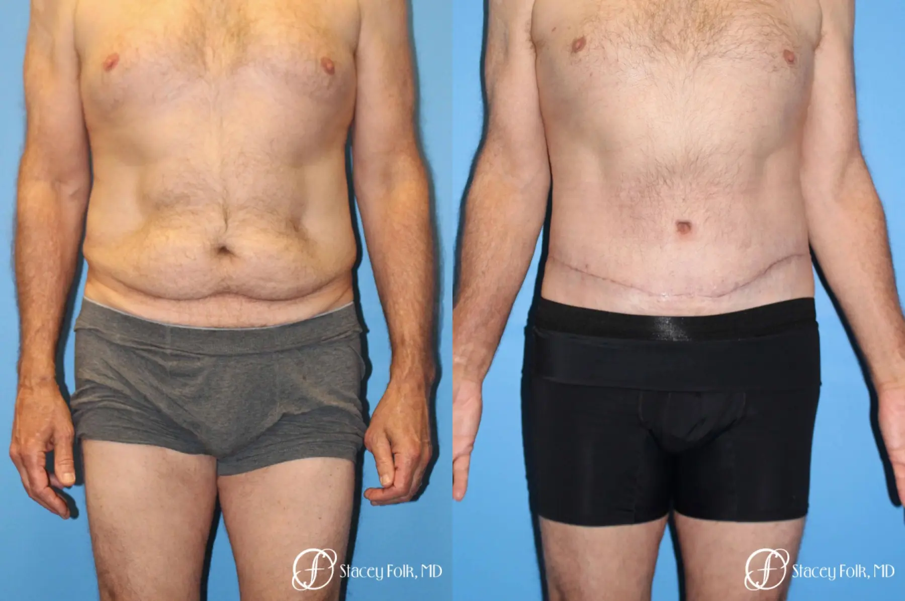 Denver Body Lift - Belt Lipectomy 8570 - Before and After 1
