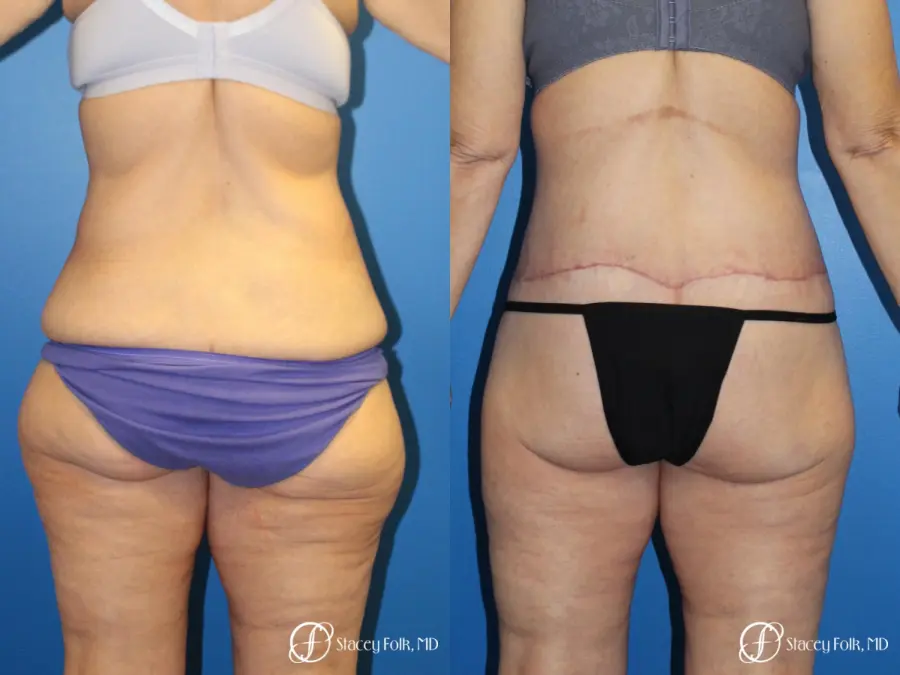 Denver Body Lift 10301 - Before and After 2