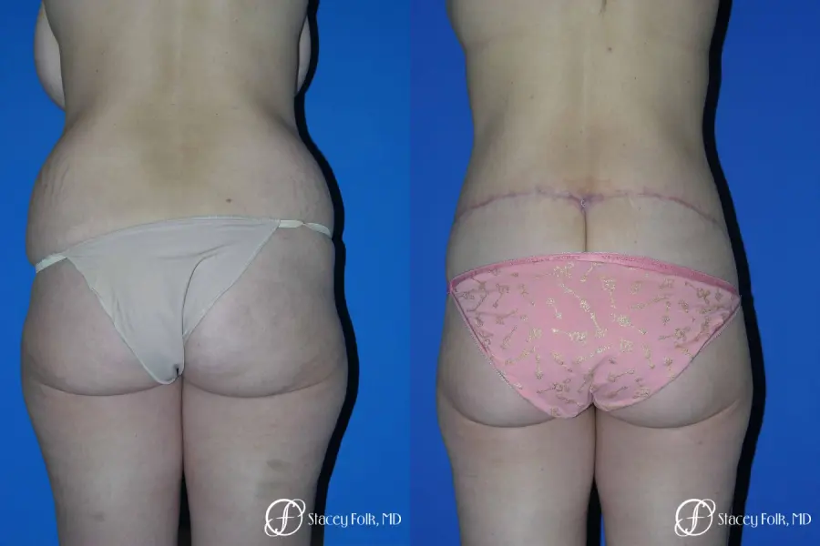 Denver Body Lift Belt lipectomy 5262 - Before and After 2