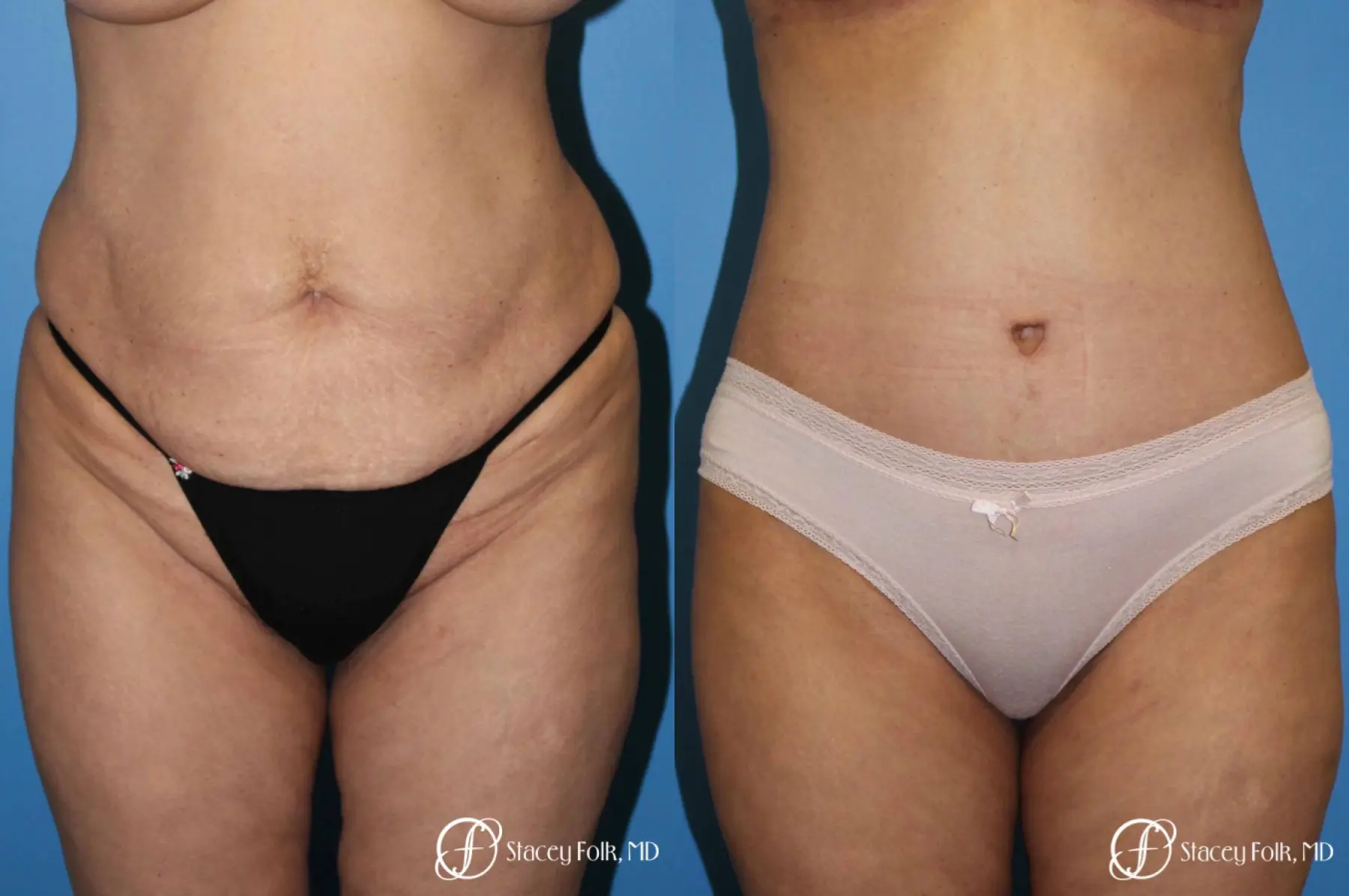 Fox Valley Plastic Surgery  Body Lift Surgery (Lipectomy)