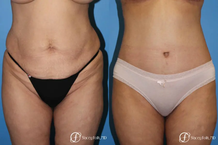 Denver Body lift 4818 - Before and After 1