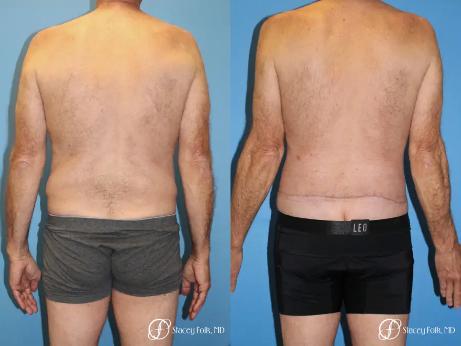 Denver Body Lift - Belt Lipectomy 8570 - Before and After 2
