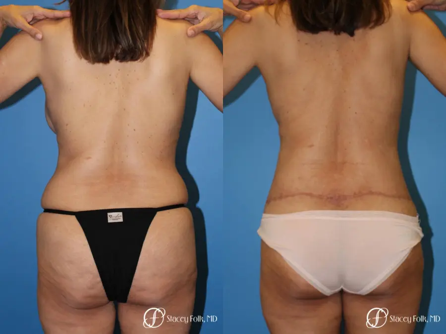 Denver Body lift 4818 - Before and After 2