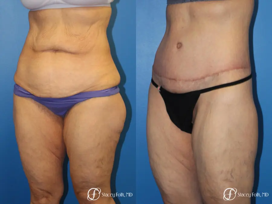 Denver Body Lift 10301 - Before and After 3