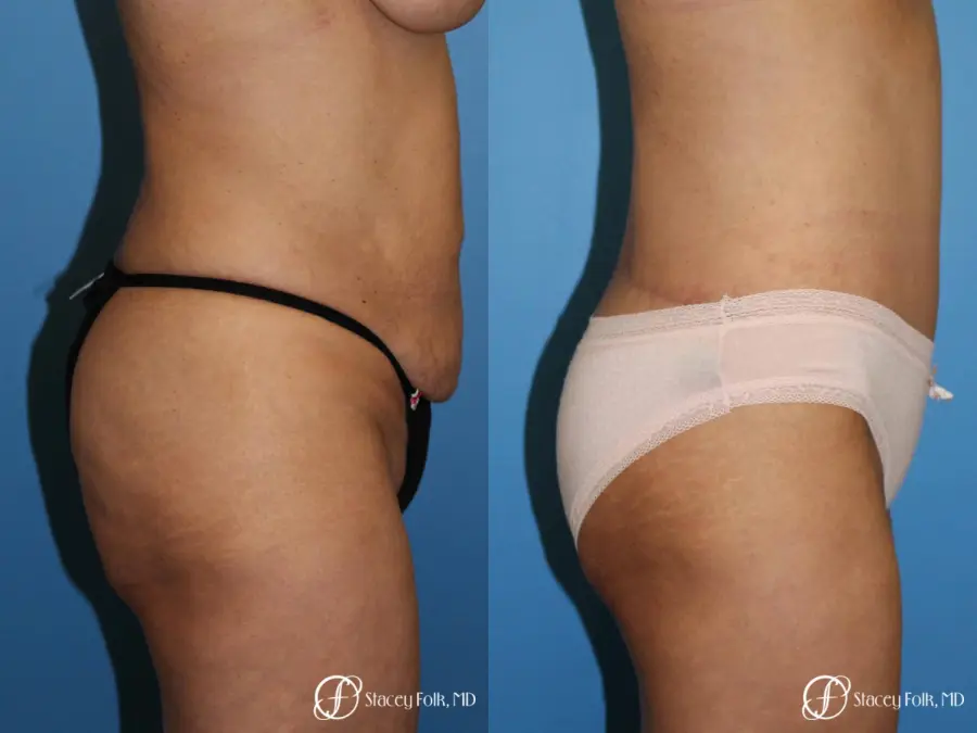 Denver Body lift 4818 - Before and After 3