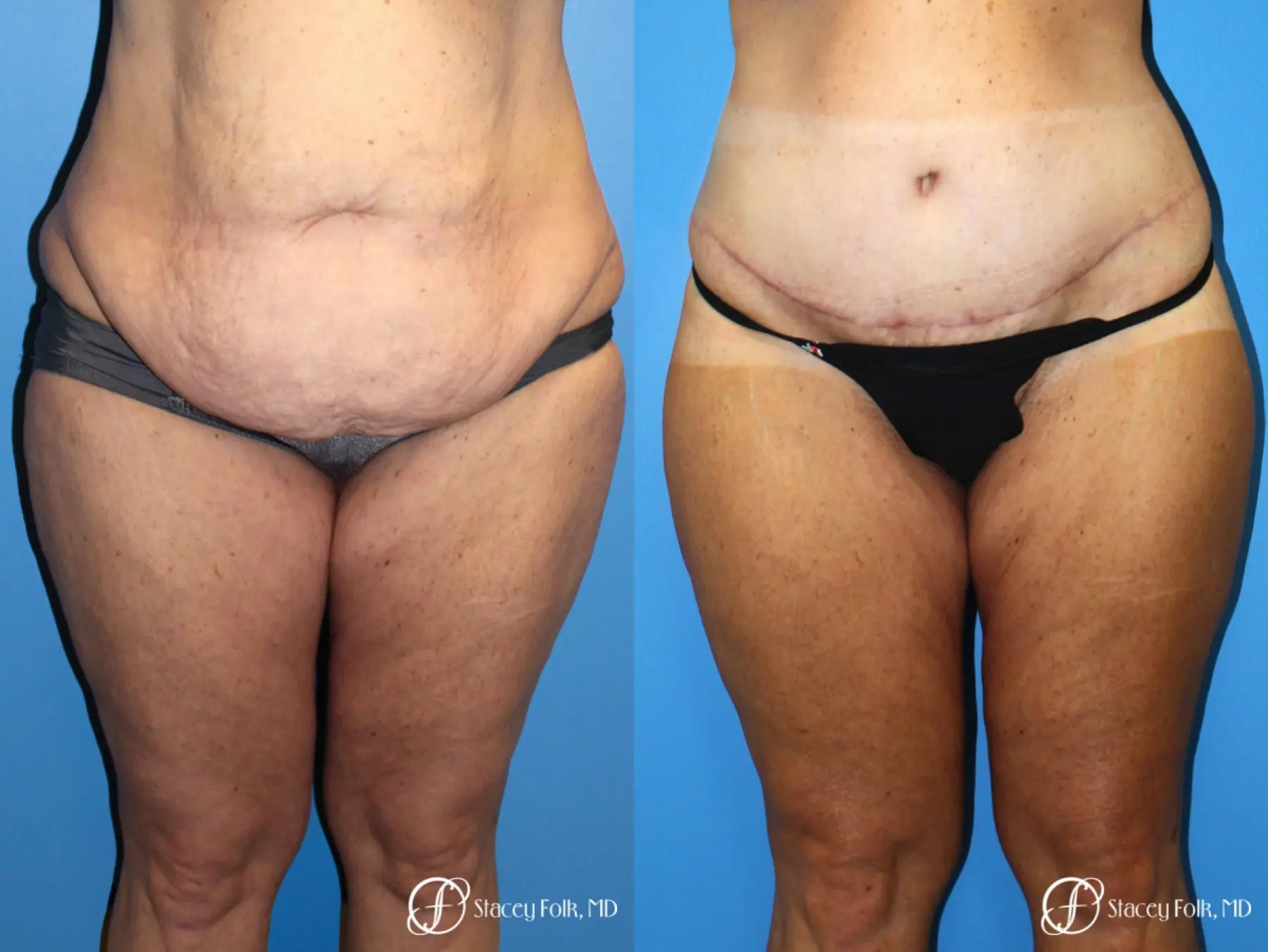 Denver Body Lift belt lipectomy, liposuction, mastopexy 5935 - Before and After