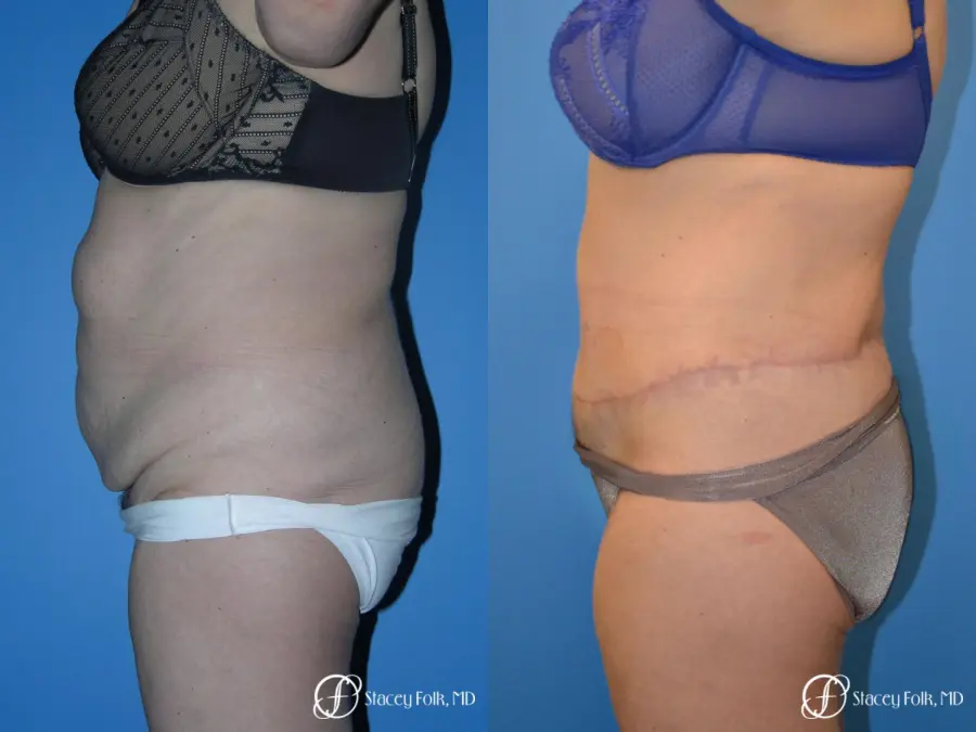 Denver Body Lift 4796 - Before and After 3