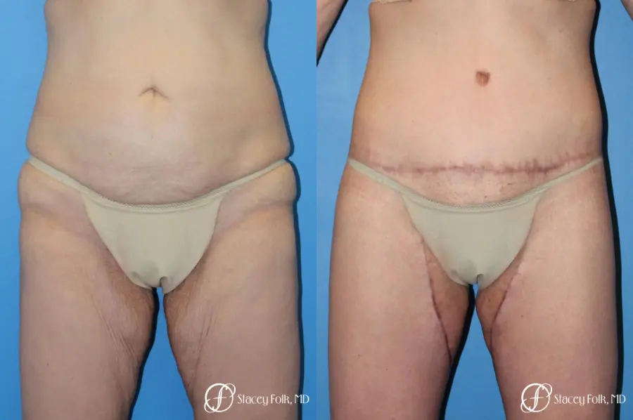 Denver Body Lift Belt lipectomy 5268 - Before and After