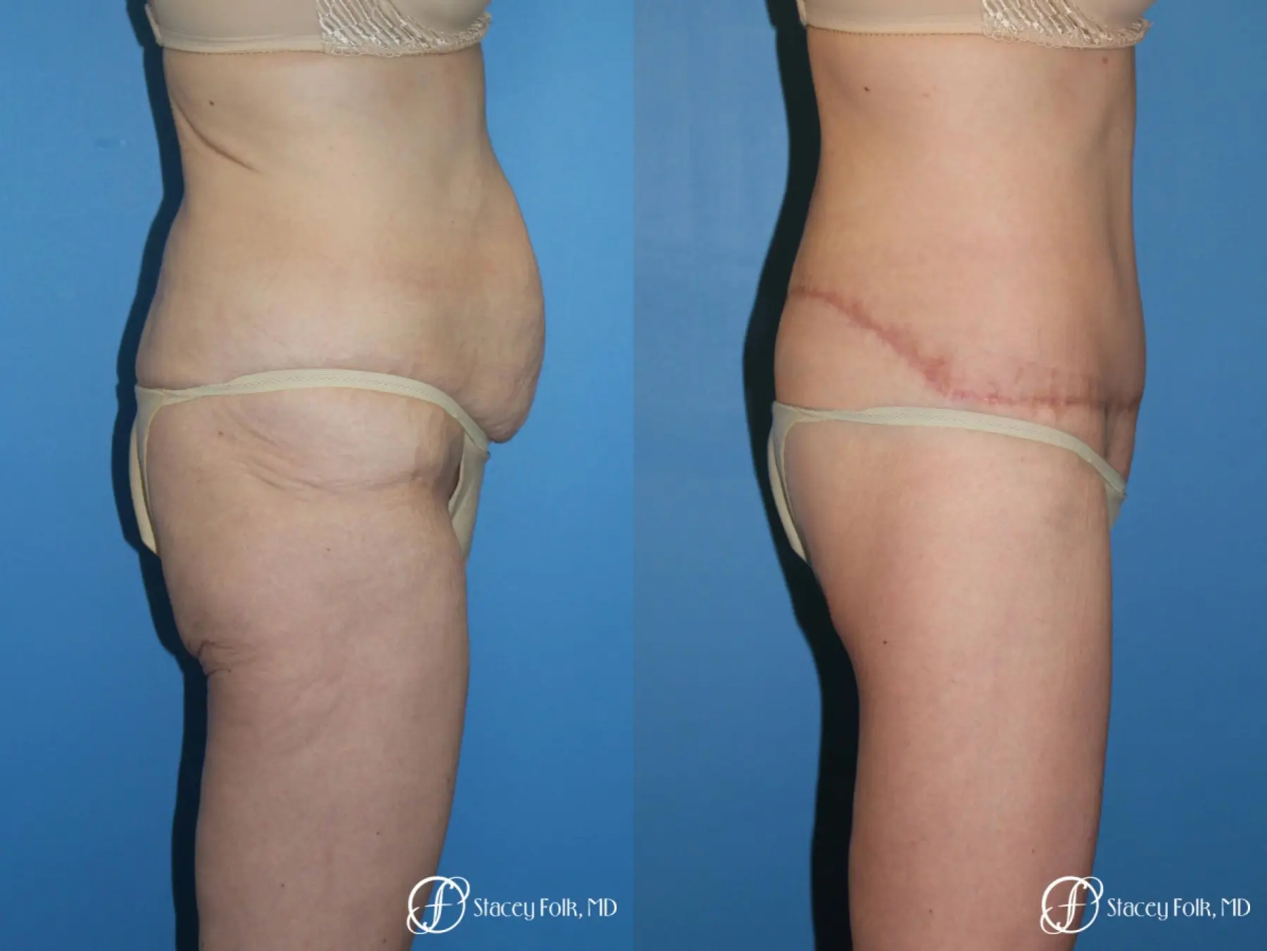 Body Lift Before & After Gallery: Patient 7