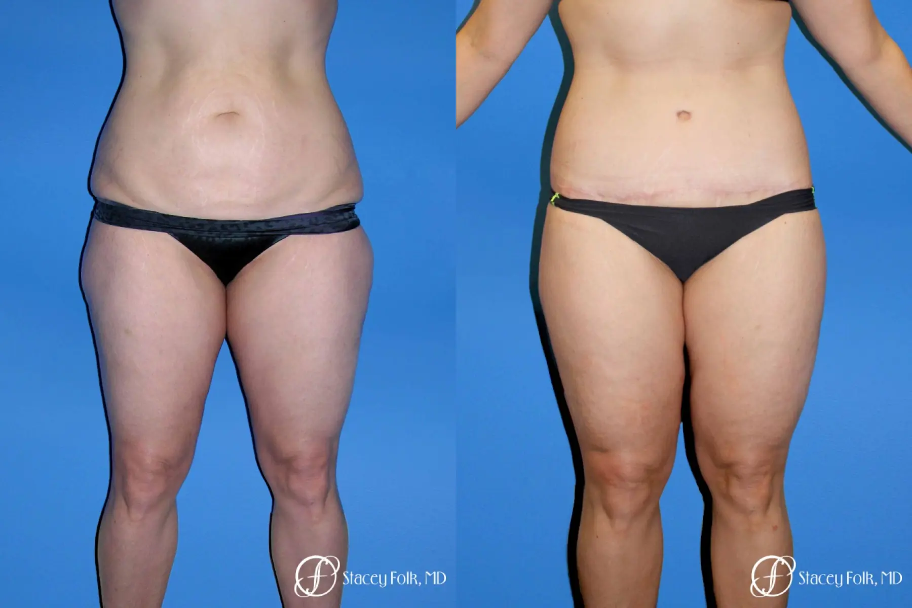 Denver Body Lift Belt lipectomy & liposuction 5264 - Before and After