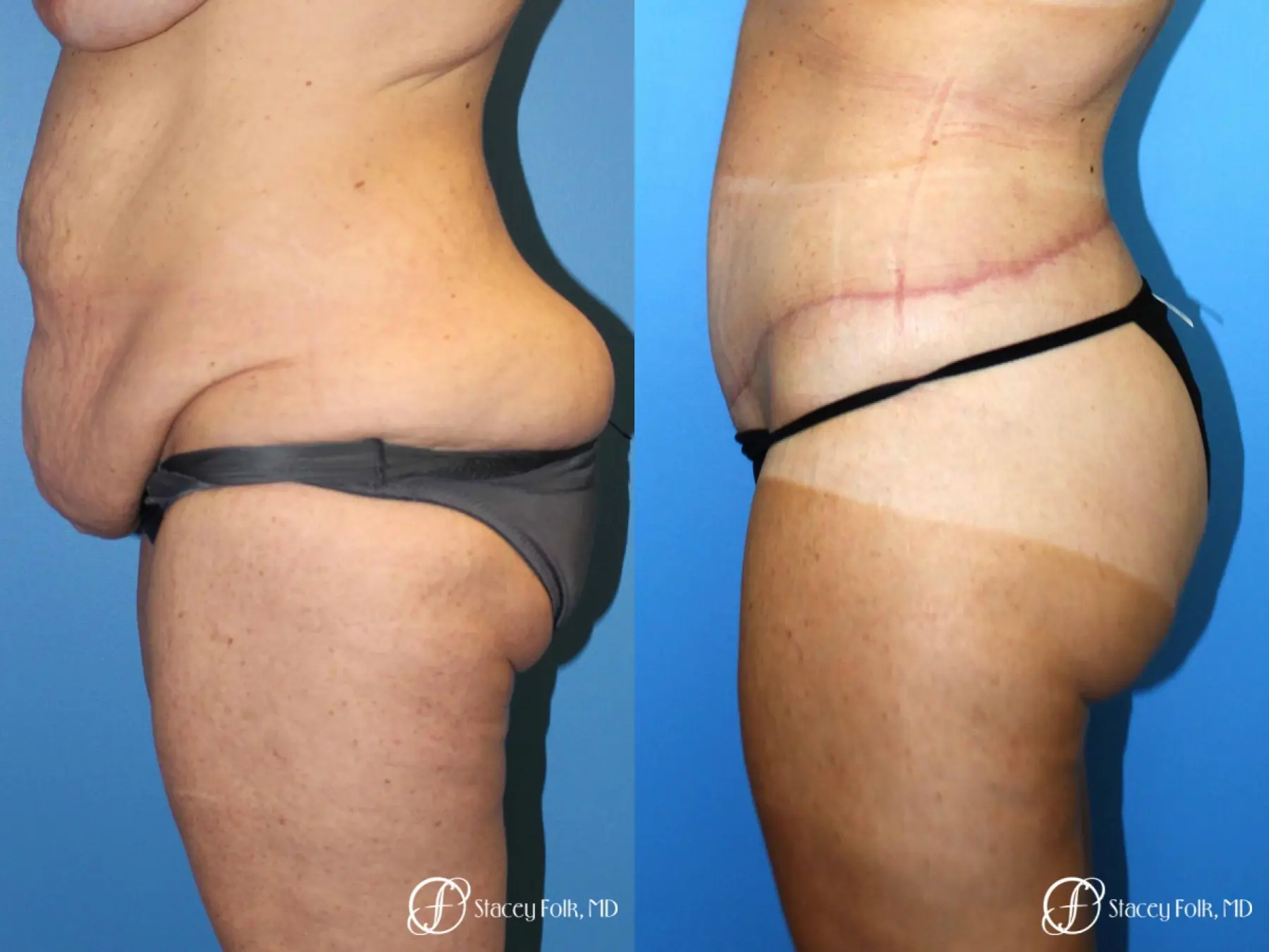 Denver Body Lift belt lipectomy, liposuction, mastopexy 5935 - Before and After 3