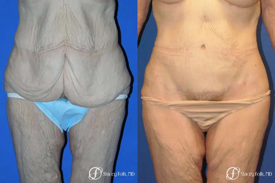 Denver Body Lift 5299 - Before and After 1