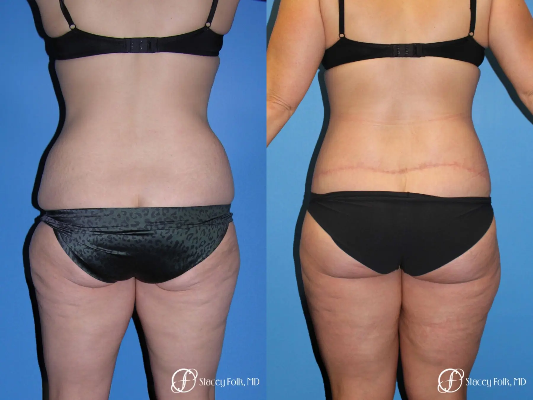 Denver Body Lift Belt lipectomy & liposuction 5264 - Before and After 2