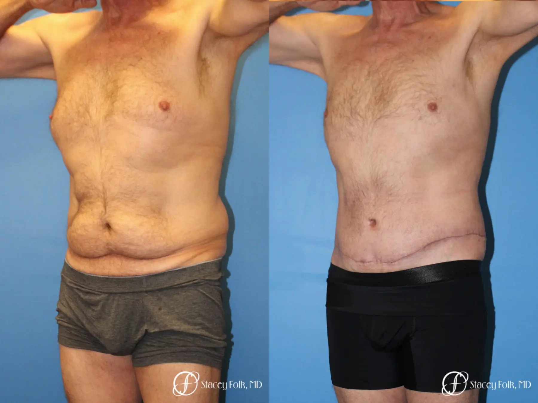 Denver Body Lift - Belt Lipectomy 8570 - Before and After 3