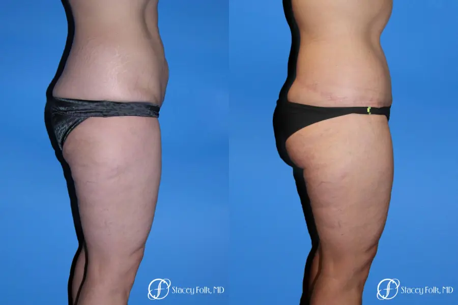 Denver Body Lift Belt lipectomy & liposuction 5264 - Before and After 3