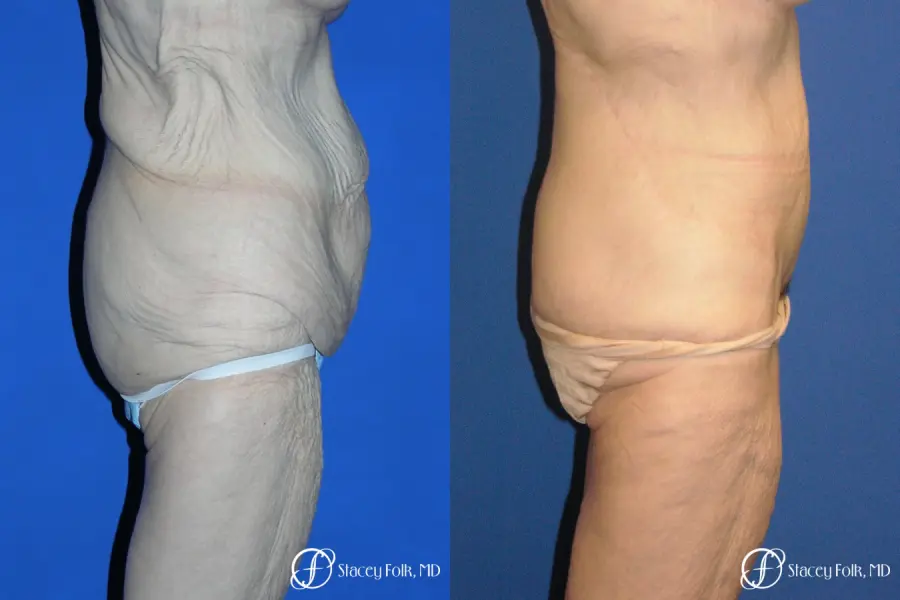 Denver Body Lift 5299 - Before and After 3