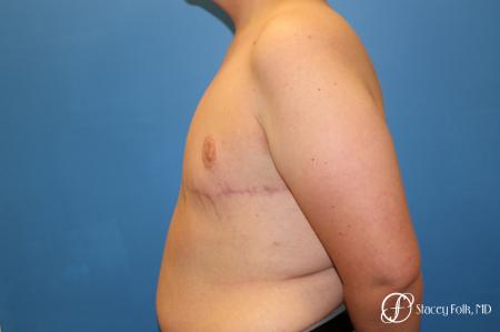 Denver FTM Female to male top surgery 5255 - After Image 5