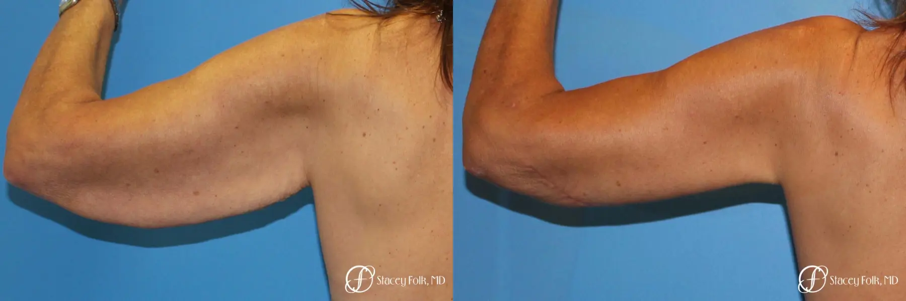 Denver Brachioplasty 8457 - Before and After 2