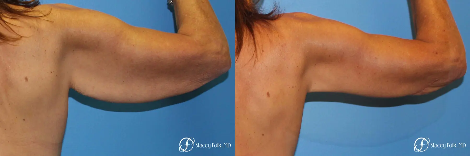 Denver Brachioplasty 8457 - Before and After 3