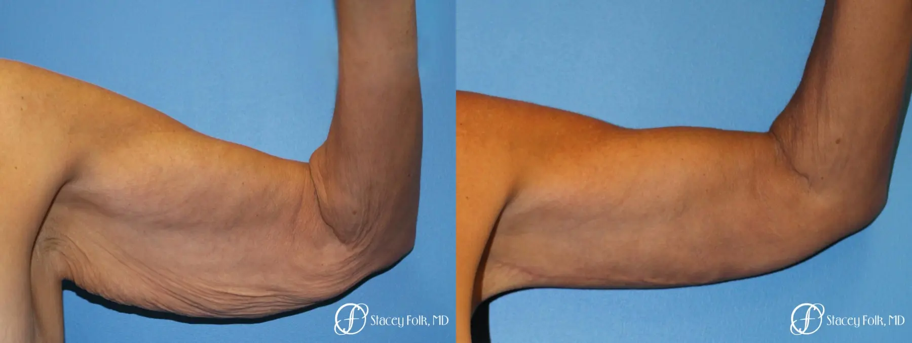 Denver Brachioplasty 8457 - Before and After 1
