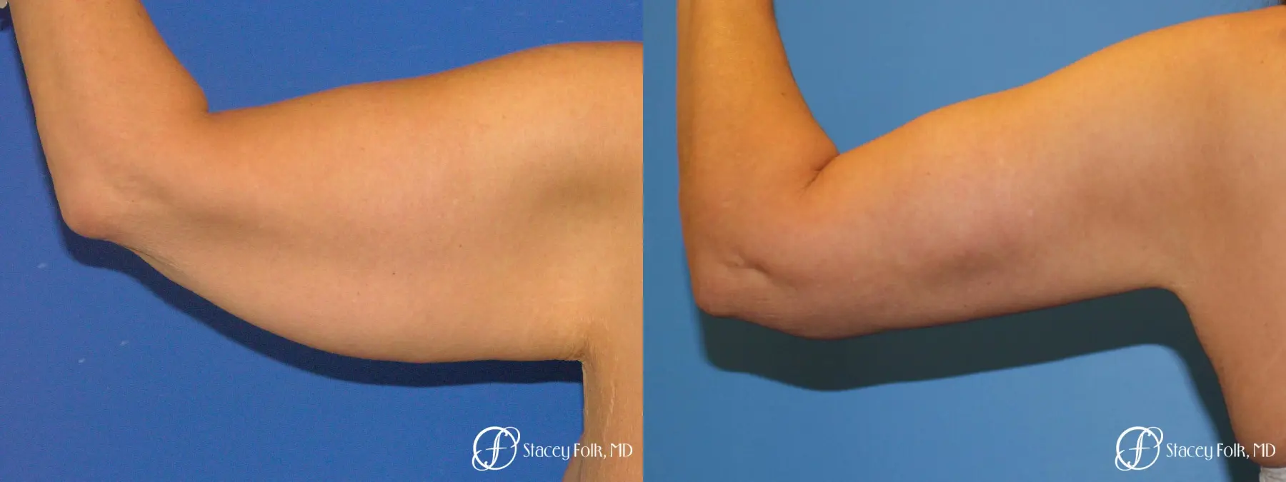 Denver Brachioplasty 8467 - Before and After 1