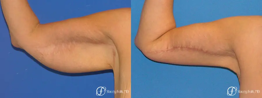 Denver Brachioplasty 8467 - Before and After 2