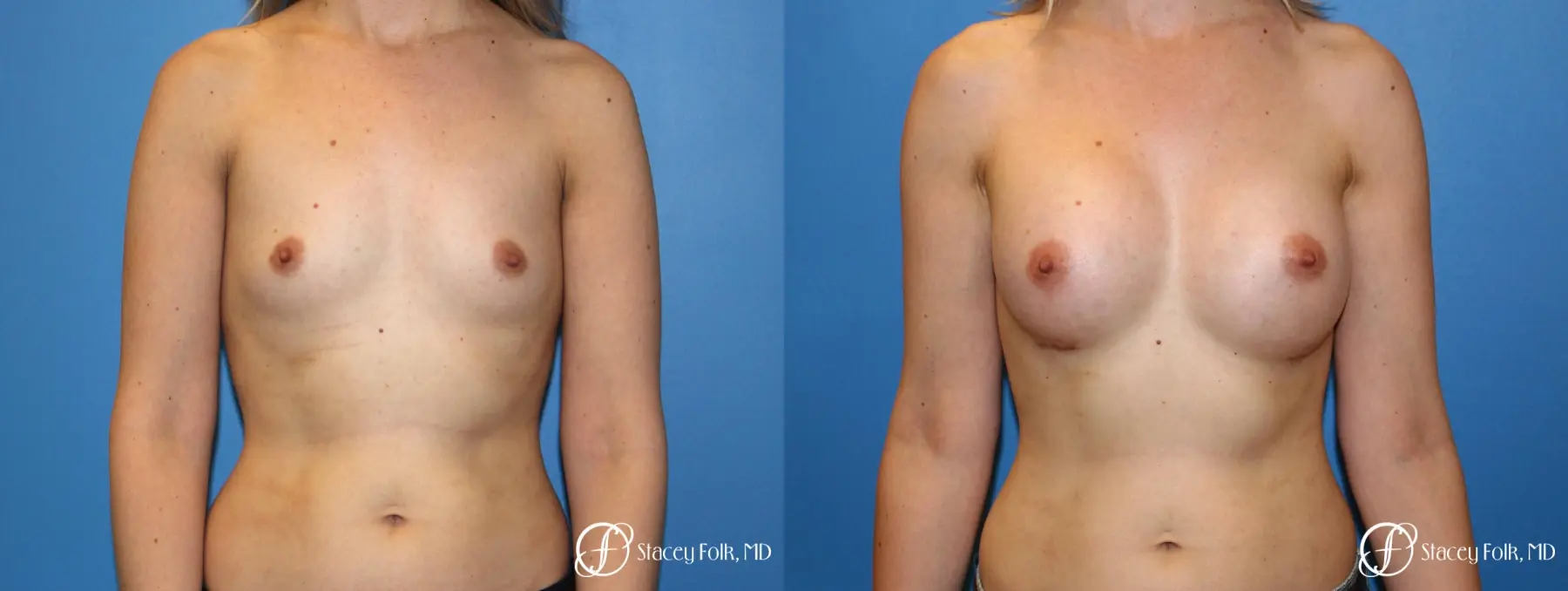Denver Breast augmentation 7110 - Before and After 1