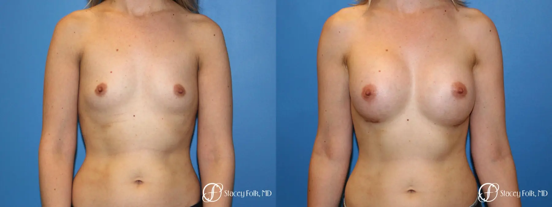 Denver Breast augmentation 7110 - Before and After