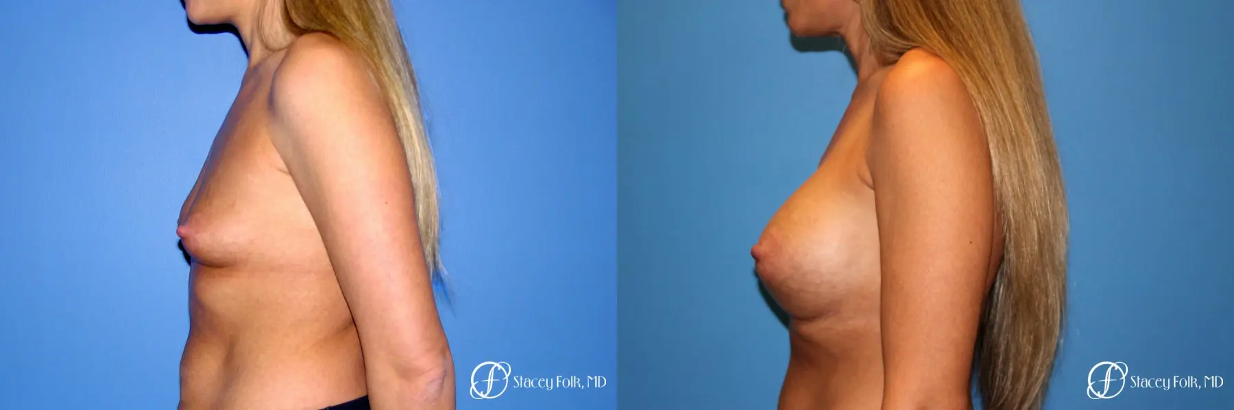 Denver Breast Augmentation 3626 - Before and After 5