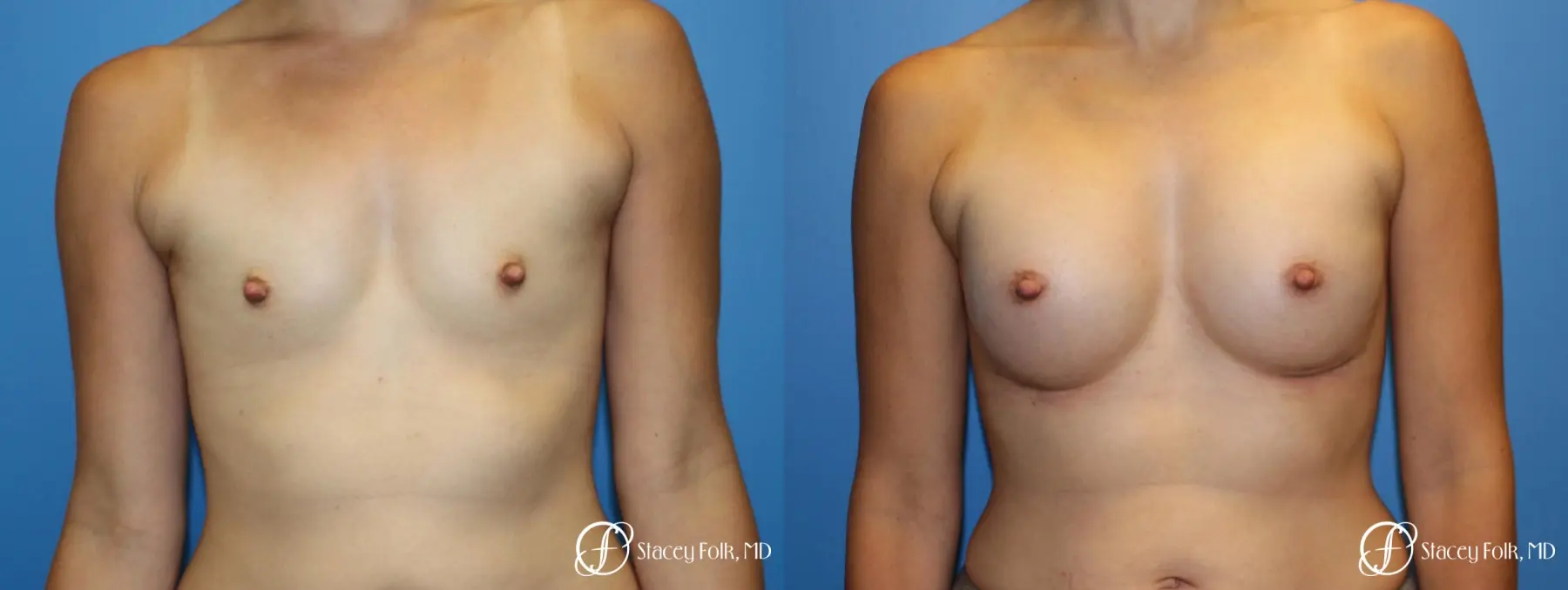 Denver Breast augmentation using textured anatomical implants 5849 - Before and After 1