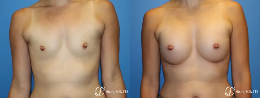 Denver Breast augmentation using textured anatomical implants 5849 - Before and After 1