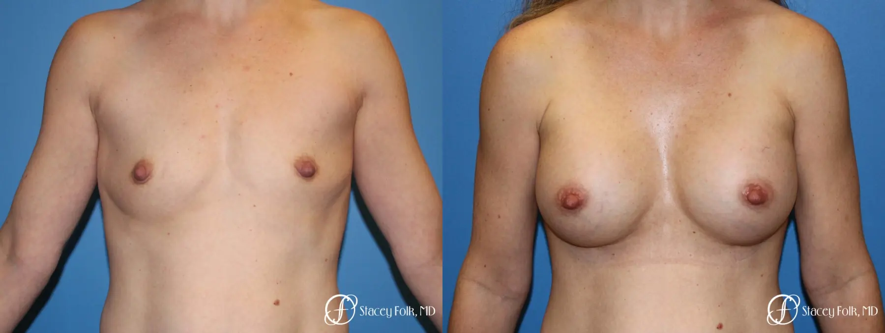 Denver Breast Augmentation using Textured Sientra Breast Implants 8414 - Before and After