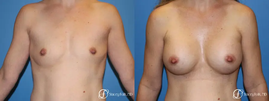 Denver Breast Augmentation using Textured Sientra Breast Implants 8414 - Before and After 1