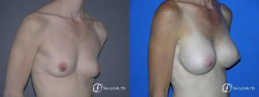 Denver Breast Augmentation 12 - Before and After 2