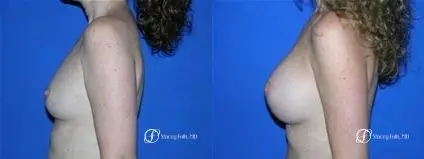 Denver Breast Augmentation 11 - Before and After 3