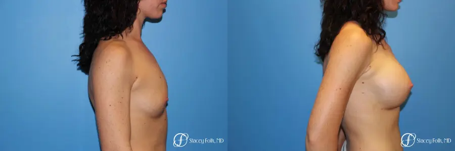 Denver Breast Augmentation using Sientra Breast Implants 7135 - Before and After 3