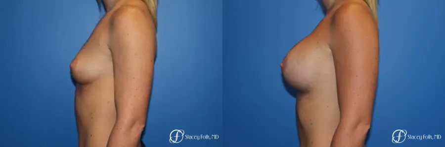 Breast Augmentation with Sientra Textured Implants - Before and After 2