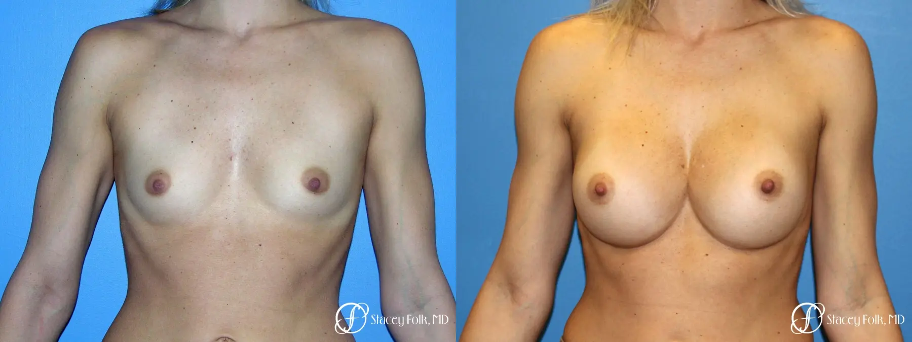 Denver Breast Augmentation 8202 - Before and After 1