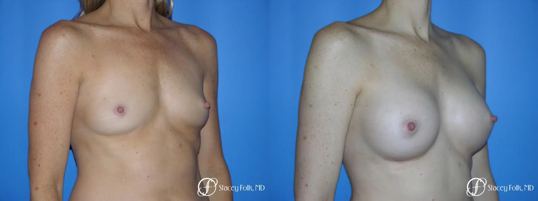 Denver Breast Augmentation 3633 - Before and After 2