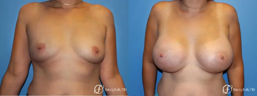 Denver Breast augmentation using textured implants 8271 - Before and After 1